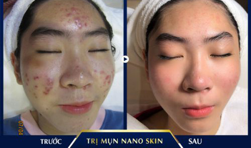 trị mụn lưng