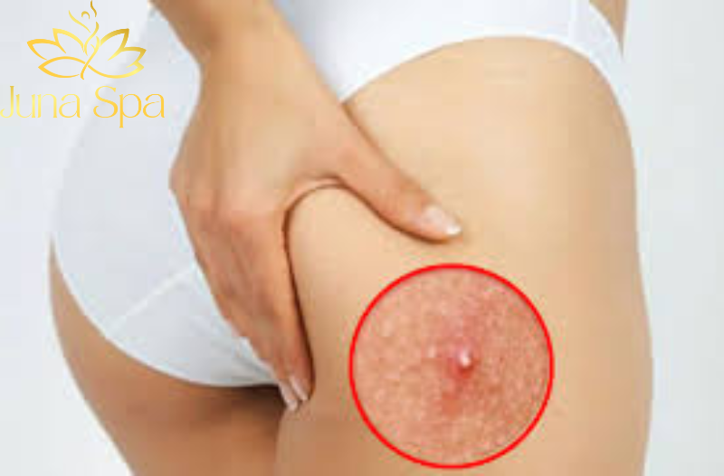 Làm sao để không bị mọc mụn ở mông?