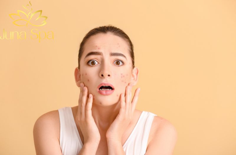 Mụn viêm bị vỡ có sao không