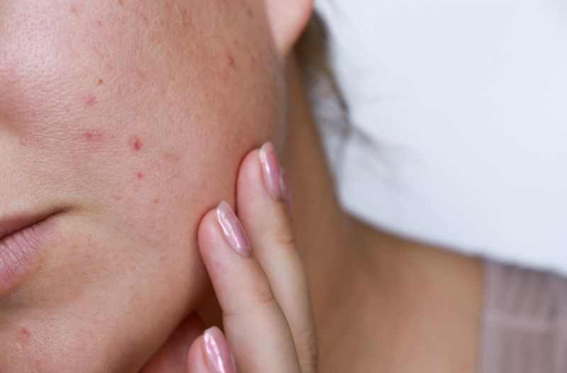 Hướng dẫn cách nặn mụn chín