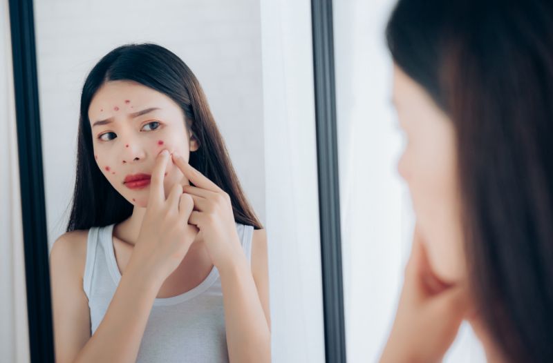 Làm sao biết được khi nào mụn đủ chín để nặn
