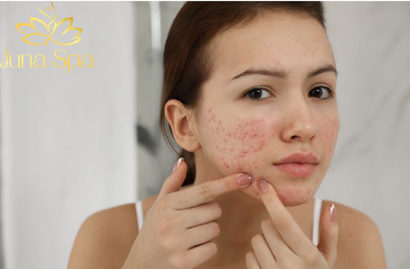 Hướng dẫn chi tiết cách xử lý mụn viêm vỡ tại nhà
