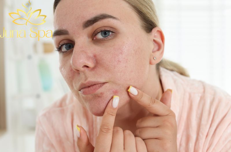 Các bước xử lý mụn viêm bị vỡ cơ bản nhất