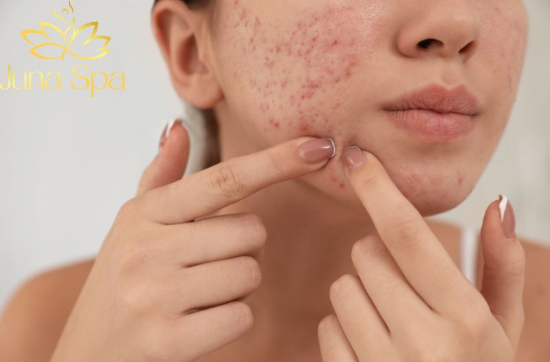Các tips cải thiện mụn viêm